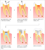 歯を長持ちさせる根管治療